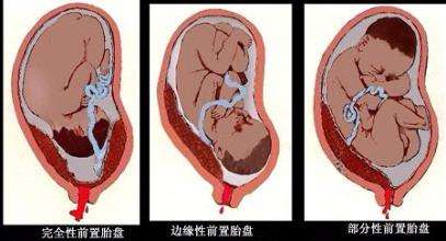 孕早期出血是怎样的,孕早期出血是怎么样的