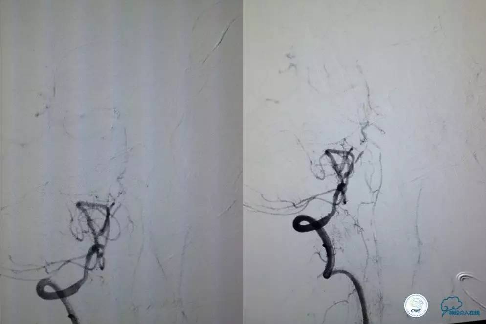 急性缺血性卒中静脉溶栓2018指南,急性缺血性卒中血管内再通标准
