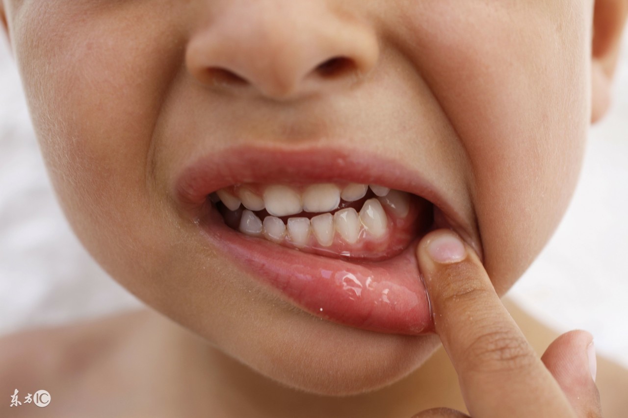 4岁小孩牙齿发黑烂掉要看牙医吗,儿童牙齿有黑渍要去看医生吗