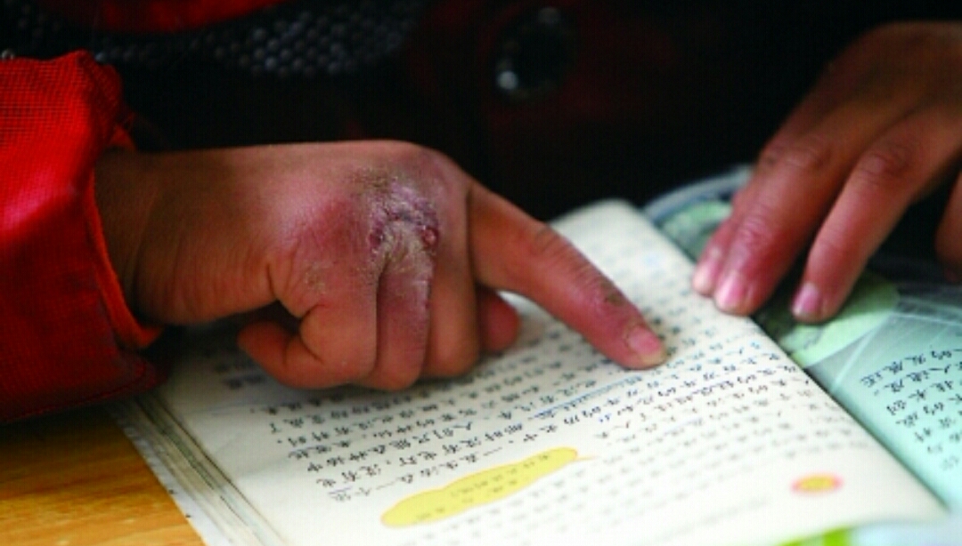 冻伤疮最佳治疗方案,冻伤疮什么意思