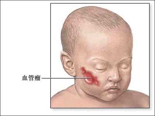婴儿血管瘤常规治疗,皮肤血管瘤治疗方法