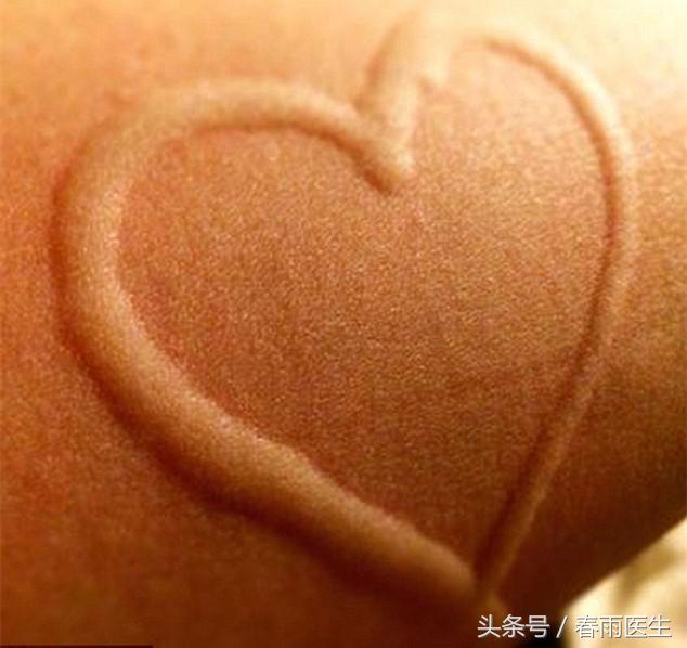 皮肤碰一下就有印子,皮肤轻轻一动就是红印子怎么回事