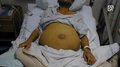 如何使肚子大,肚子大怎么判断是不是肝腹水