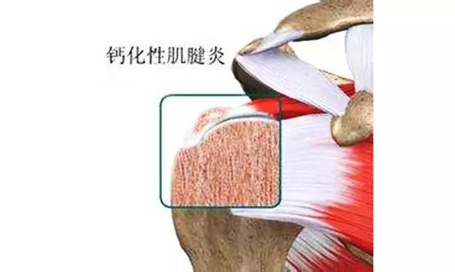 肩疼膀子疼去医院挂什么科,颈椎疼和肩疼会引起其它什么病