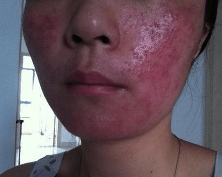 怎么才能消除激素脸,怎么彻底治好激素脸