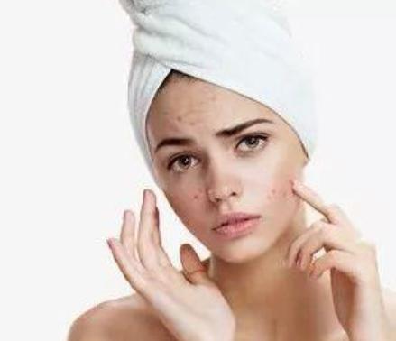 急救熬夜长痘精华,教你6招解决熬夜肌肤问题