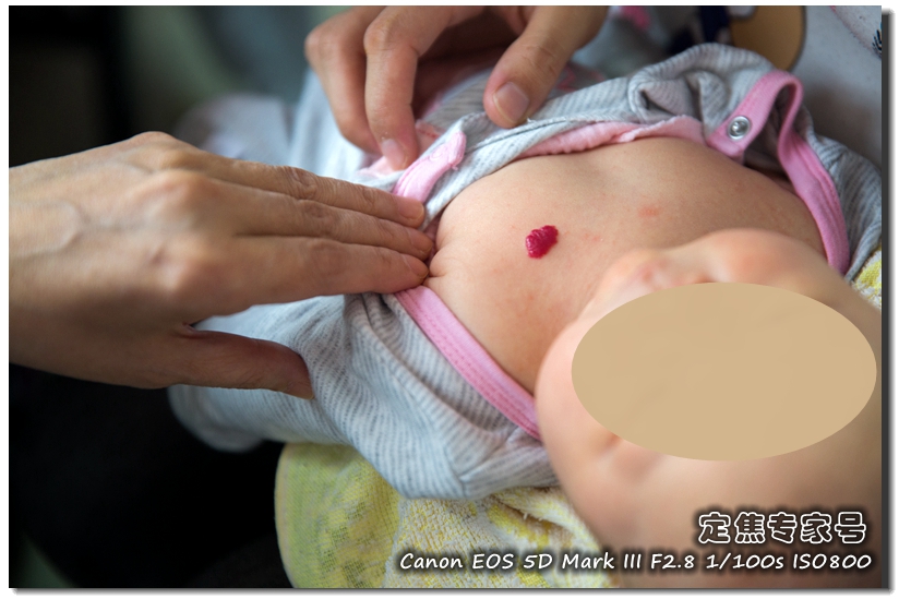 治疗头皮癣要多少钱,头皮上红斑为什么难治好