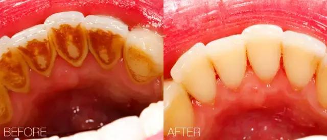 洗牙有什么副作用吗,洗牙怎么不伤牙