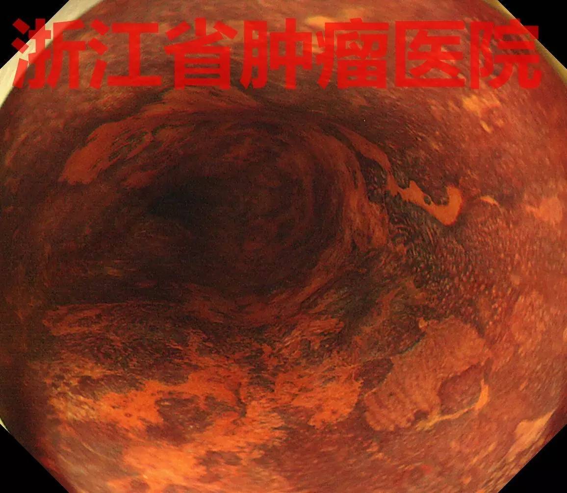 食管大面积黏膜病变,看看这家医院如何处理?!