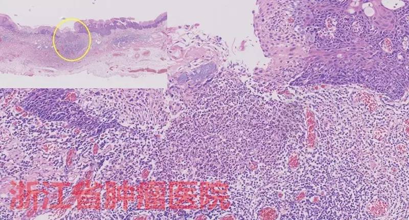 食管大面积黏膜病变，看看这家医院如何处理？！