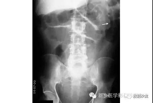 详细腹部平片解剖+正常表现+读片技巧+病例分析