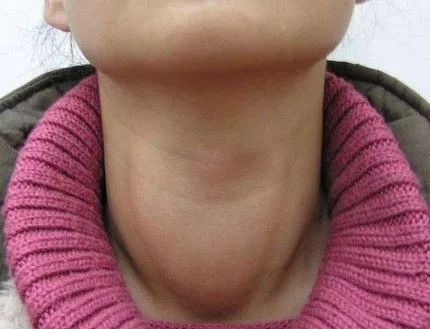 桥本氏甲状腺炎如何保养,按摩什么穴位可以保养甲状腺