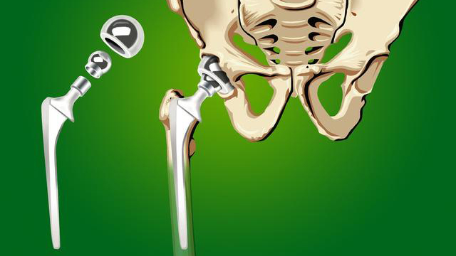 股骨颈骨折怎么才能恢复得快,股骨颈骨折一般多久可以下地负重