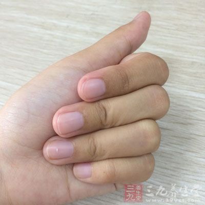 指甲上有这种白点你该注意了