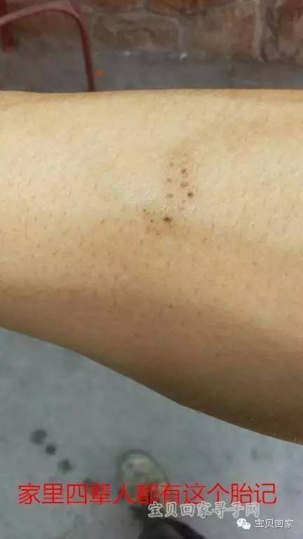 手臂上镌刻家族天然“烙印”的你，知道还有个姐姐在等你吗？