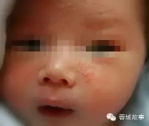 教你对付湿疹,别让湿疹误了宝宝颜值