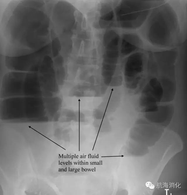肠梗阻需要解决疑难护理问题,肠梗阻是大肠还是小肠问题
