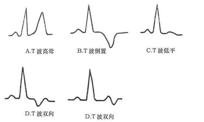 年轻人心肌缺血容易治愈吗,年轻人心肌缺血自己会治愈吗
