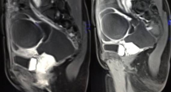 中下腹胀痛见于哪些疾病,女性下腹坠痛是不是有炎症