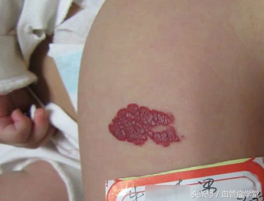 眼药水可以治疗血管瘤,什么眼药水可以治血管瘤