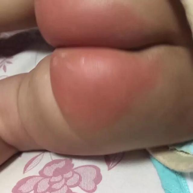 40天的宝宝屁屁烂了怎么办,40天的宝宝屁屁掉皮
