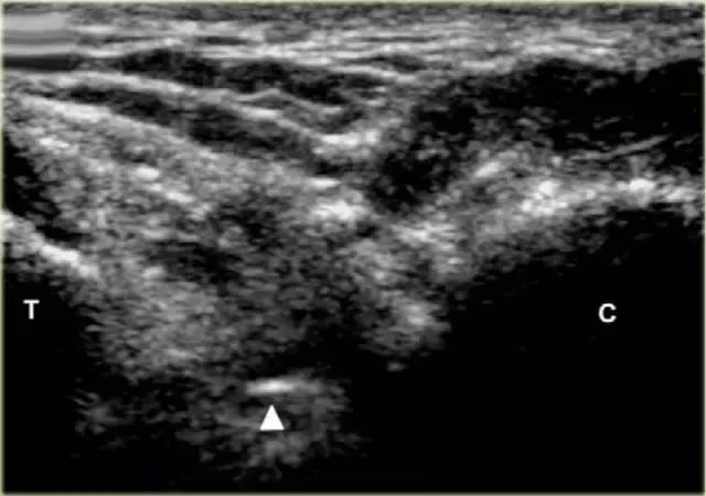 超声引导穿刺和介入穿刺的优缺点,关节超声引导