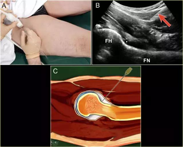 超声引导穿刺和介入穿刺的优缺点,关节超声引导