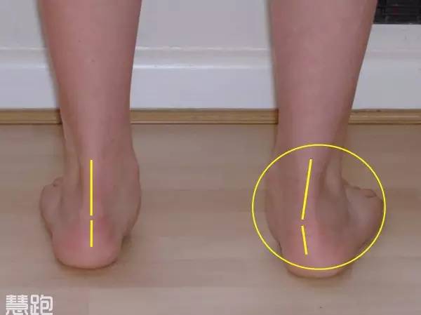 全球治好足跟痛,足底疗法治百病