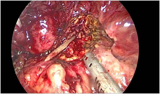 胃里有个大肿块是怎么回事,胃突然有个硬包怎么回事