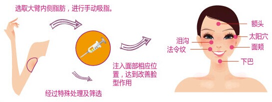 做自体脂肪丰唇多少钱,做自体脂肪填充泪沟多少钱