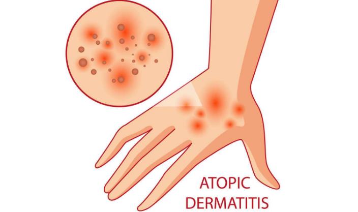 发红发痒还有皮屑是脂溢性皮炎吗,皮肤发红痒脂溢性皮炎