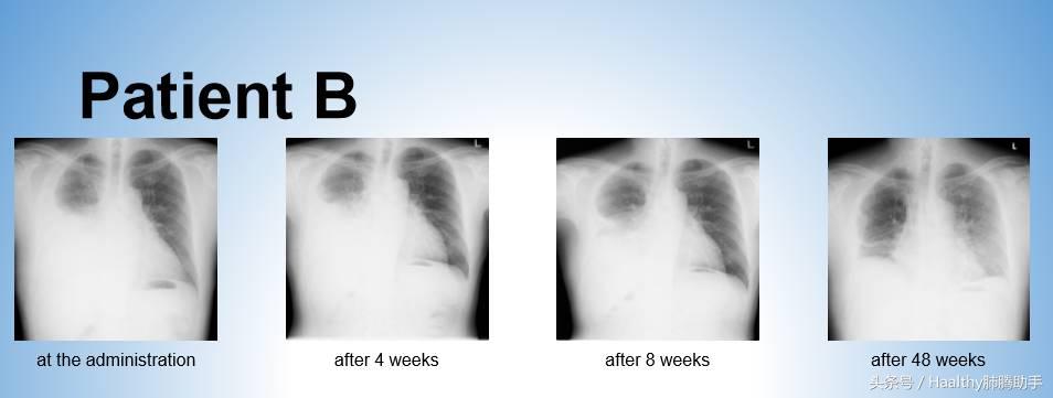 肺癌胸腔积液缓解办法,肺癌出现胸腔积液怎么治疗