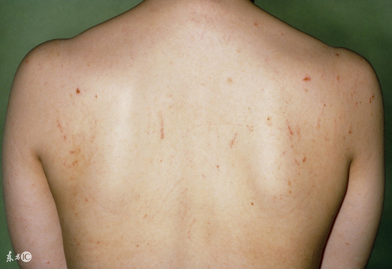 草鱼疥疮病的防治,疥疮防治意见