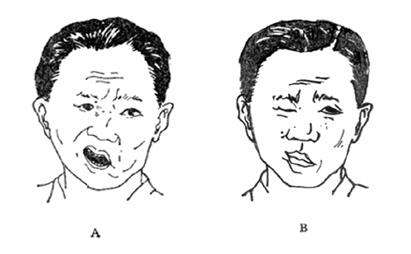面部失去知觉是什么原因引起的,面部识别失灵是什么原因
