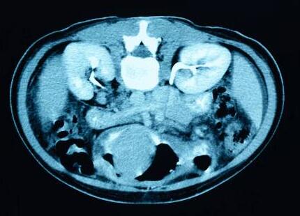 肾结石是什么原因造成的怎么办,肾结石是什么原因造成的怎么治