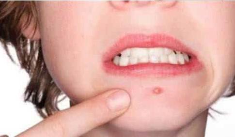 耳朵边长痘痘是什么原因,眉毛处长痘痘是什么原因