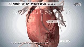 不做支架不搭桥中医调理冠心病,冠心病支架和搭桥的条件