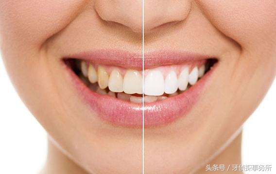 牙齿美白和冷光美白有啥区别,牙齿黄了很多年冷光美白仪有用吗