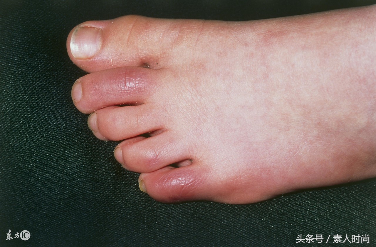 经常穿打底裤有什么危害,长期穿压力裤有什么危害