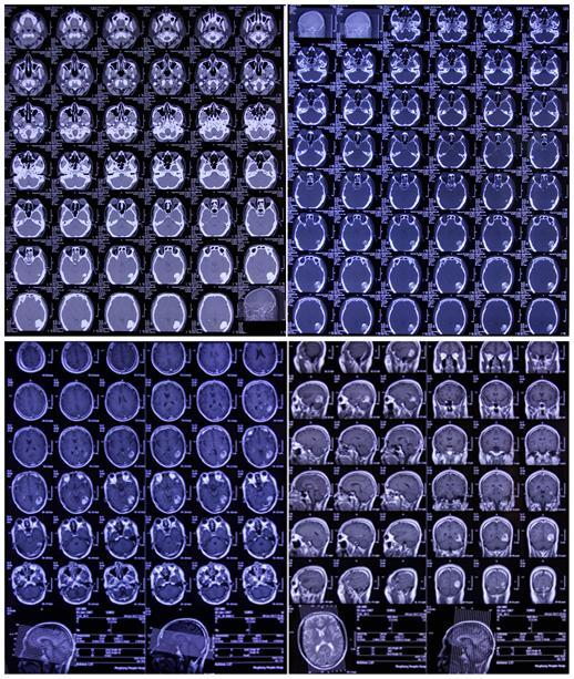 小脑幕脑膜瘤手术成功率,左侧枕部大脑镰旁脑膜瘤严重么