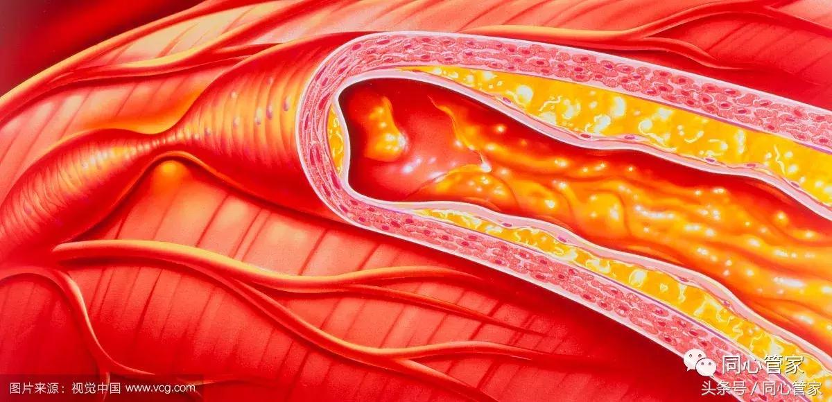 动脉硬化应如何准确测量血压,动脉硬化检测时血压准确吗