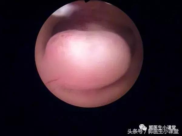 豆浆喝多了会得子宫内膜癌吗,豆浆喝多了容易得子宫肌瘤吗