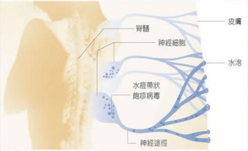 带状疱疹后神经痛后遗症自我修复,带状疱疹神经痛镇痛药