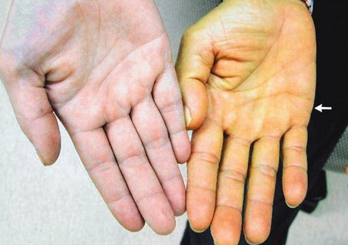 乙肝病毒dna定量变化与什么有关,得了乙肝病毒需要注意什么