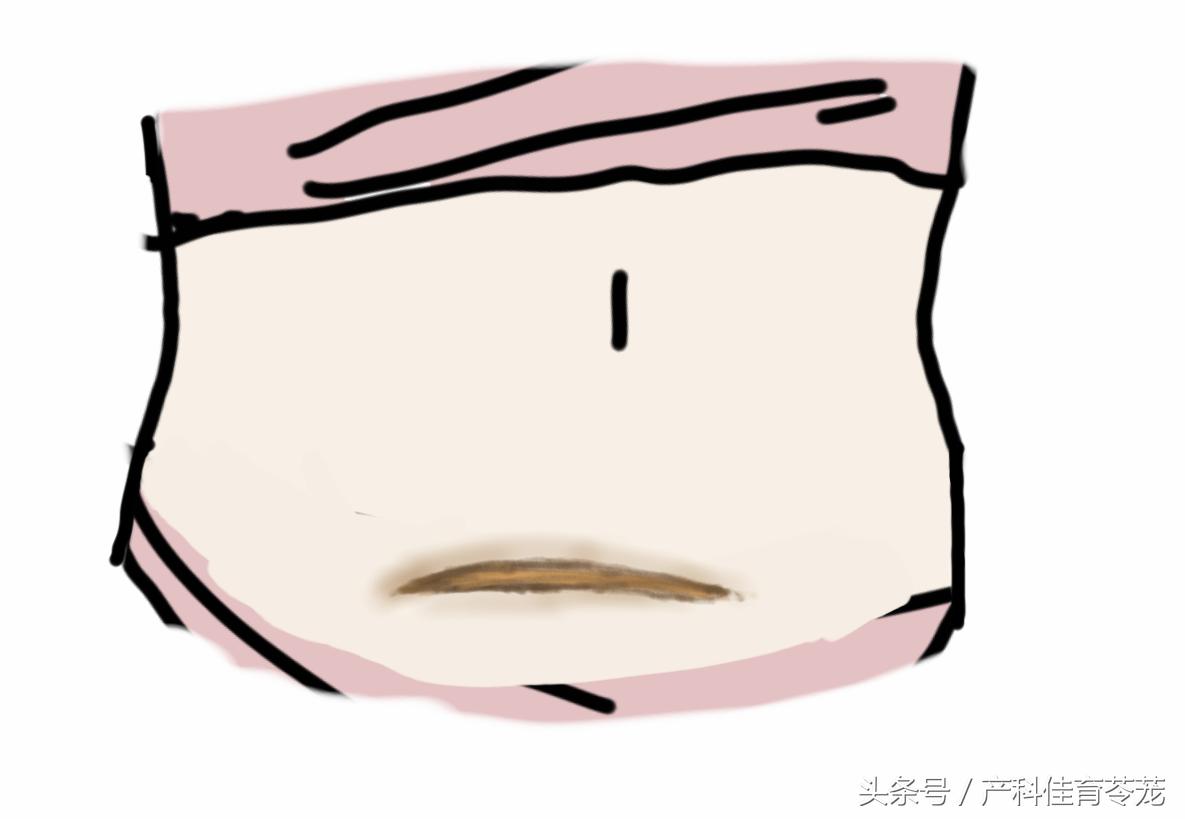 剖宫产疤痕开始痒怎么缓解,剖宫产后预防瘢痕的小技巧