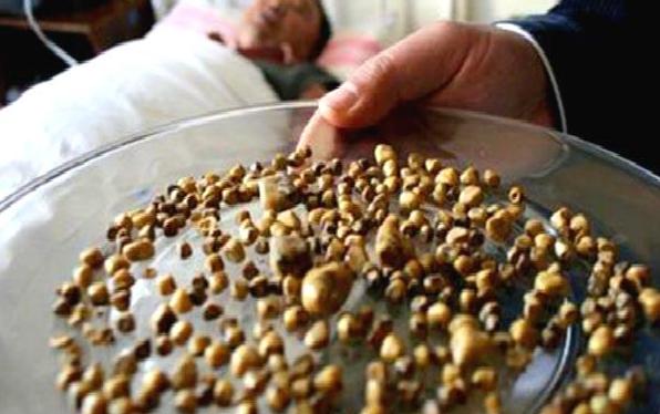 治疗结石最好的偏方,治好结石的方法有哪些