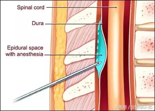 无痛分娩后期会腰痛吗,无痛分娩后期有危险吗