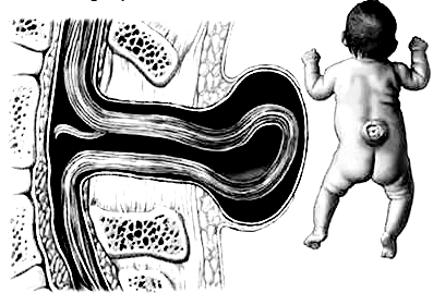 隐性脊柱裂尿床手术要多少费用,孩子隐匿性脊柱裂有影响吗