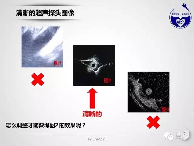 内镜超声小探头设定、使用、维护要点分析