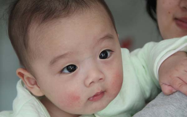 小孩子皮肤干裂怎么办,小孩冬天皮肤干裂用什么护肤品